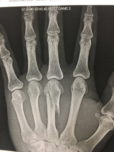 X-Ray